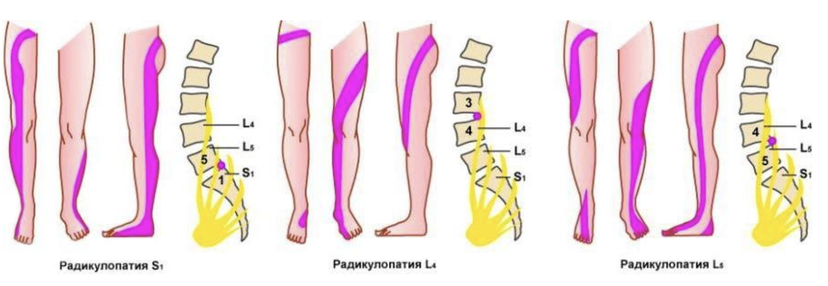 Боль в ногах от бедра до стопы. Вертеброгенная радикулопатия поясничного отдела l5 s1. Радикулопатия диска l3-l4. Радикулопатия l2-l3. Синдром корешка l4 диск l3-l4.