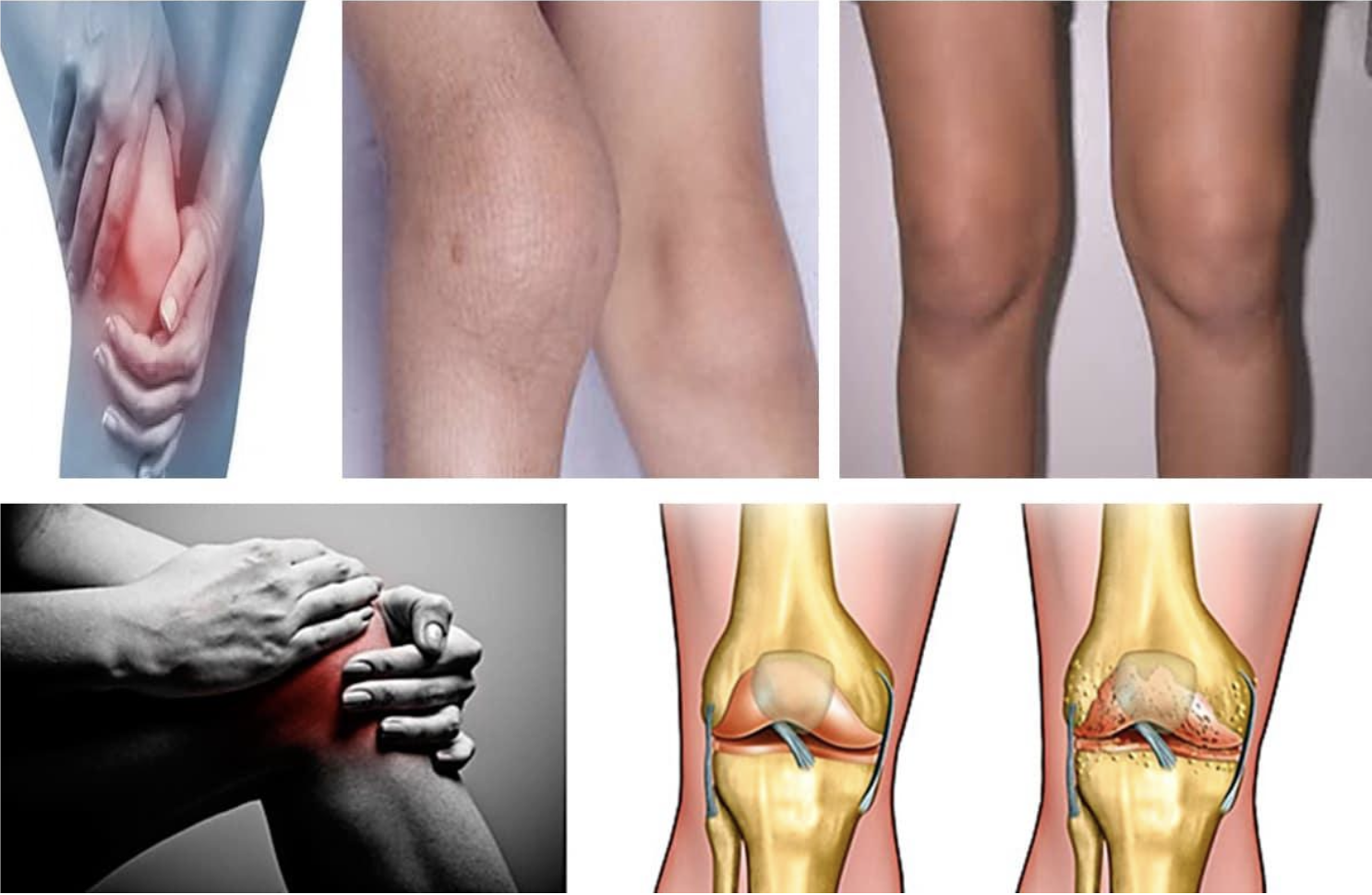 Сустав 1а. Гонартроз остеоартроз. Гонартроз коленного сустава 2. Деформирующий гонартроз коленного сустава 2-3 степени. Остеоартроз коленного сустава 1, 2, 3 степени.