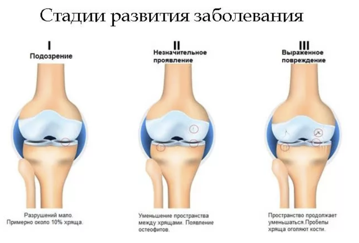Коленный сустав по стадиям. Деформирующий остеоартроз 1 степени коленного. Артроз коленного сустава 3 степени по Косинской. Гонартроз степени рентгенологические. Гонартроз 1 степени коленного.