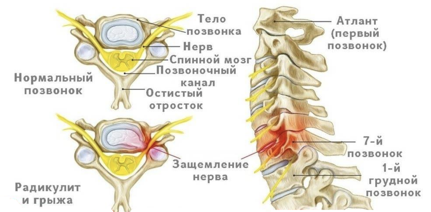 Лечение защемления нерва в грудном отделе позвоночника. Шейный отдел позвоночника защемление нервов. Защемление нервных Корешков спинного мозга. Нервы шейного отдела позвоночника. Защемление нерва в позвоночнике.
