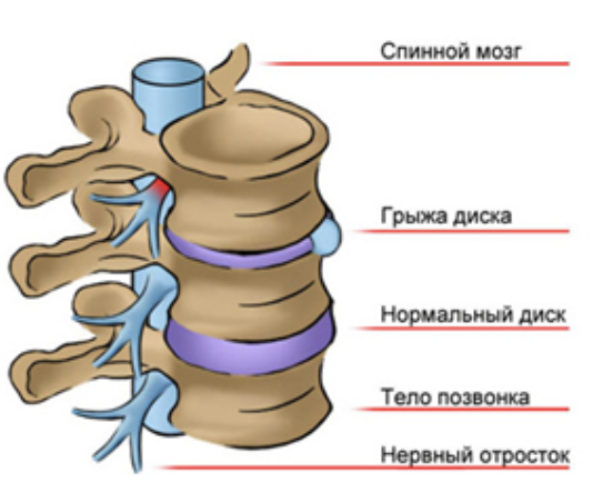 Спинной мозг при грыже позвоночника