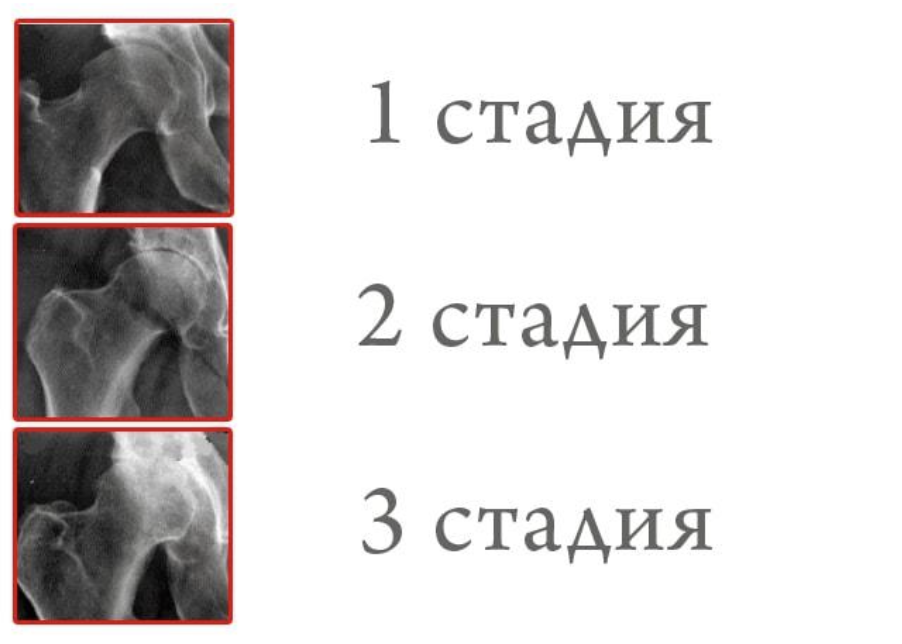 Коксартроз тазобедренного сустава рентген. Коксартроз 1 степени рентген. Снимок коксартроза тазобедренного сустава 2 степени. Коксартроз 1 стадии рентген.