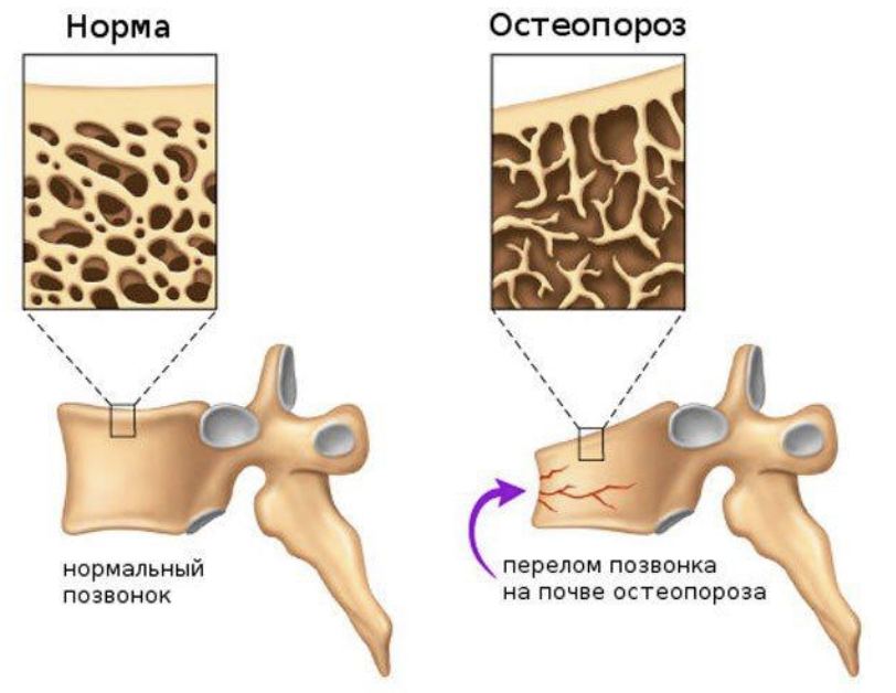 Последствия лекарственных терапий и остеопороз причины симптомы лечение