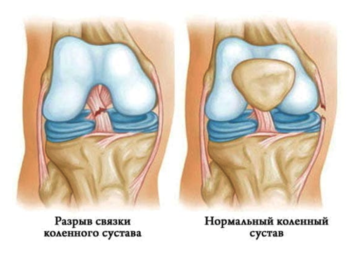 Повреждение коленной связки симптомы