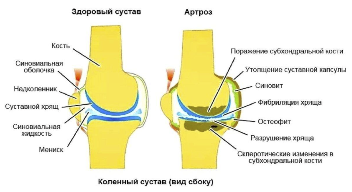 Что разрушает суставы. Коленный сустав анатомия артроз. Синовиальная мембрана коленного сустава. Остеоартрит коленного сустава синдромы. Воспаление синовиальной оболочки сустава.