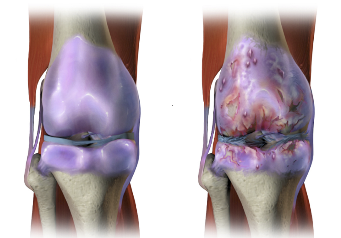 Остеоартроз 1 2 степени коленного сустава. Остеоартроз (деформирующий остеоартроз). Остеоартрит коленного сустава. Деформирующий артроз (остеоартроз). Деформирующий артроз это остеоартрит.